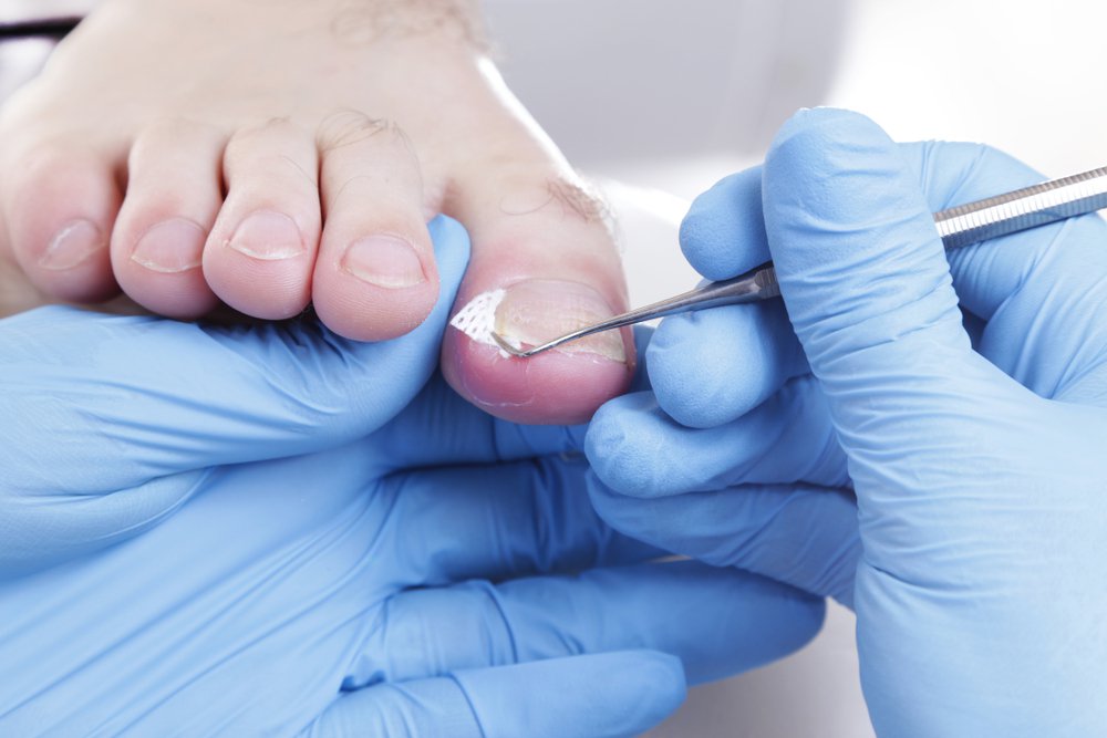 How Foot Specialists Can Help With Ingrown Toenails