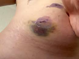 Lifestyle Changes To Make After Gallbladder Surgery