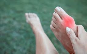 Lifestyle Changes and Treatment Strategies for Managing Bunions