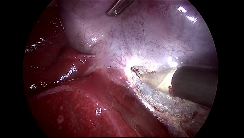 Steps To Take When Preparing for Gallbladder Removal Surgery