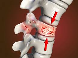 The Recovery Process After a Spine Fracture