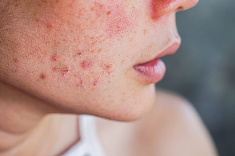 The Role of Medication for Acne Management