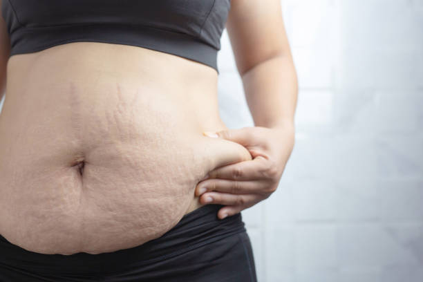 Understanding the Difference Between Traditional and Laser Liposuction