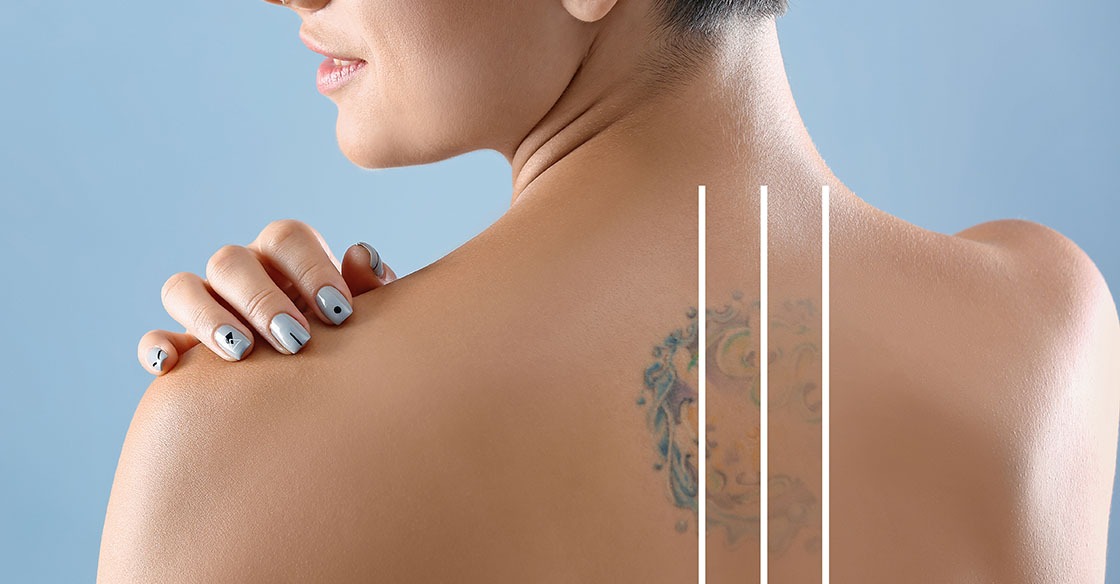 What To Know About Laser Tattoo Removal Techniques