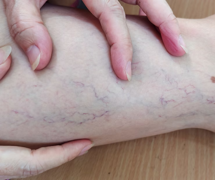 Why Early Intervention is Key for Spider Veins