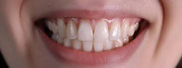 Navigating Post-Operative Care After Dental Implant Procedures