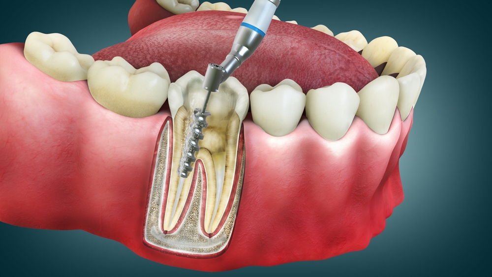 The Role of Endodontic Implants in Restorative Dentistry