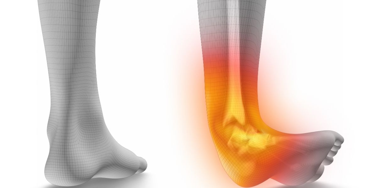 Understanding the Ankle Sprain Recovery Timeline Understanding the Ankle Sprain Recovery Timeline